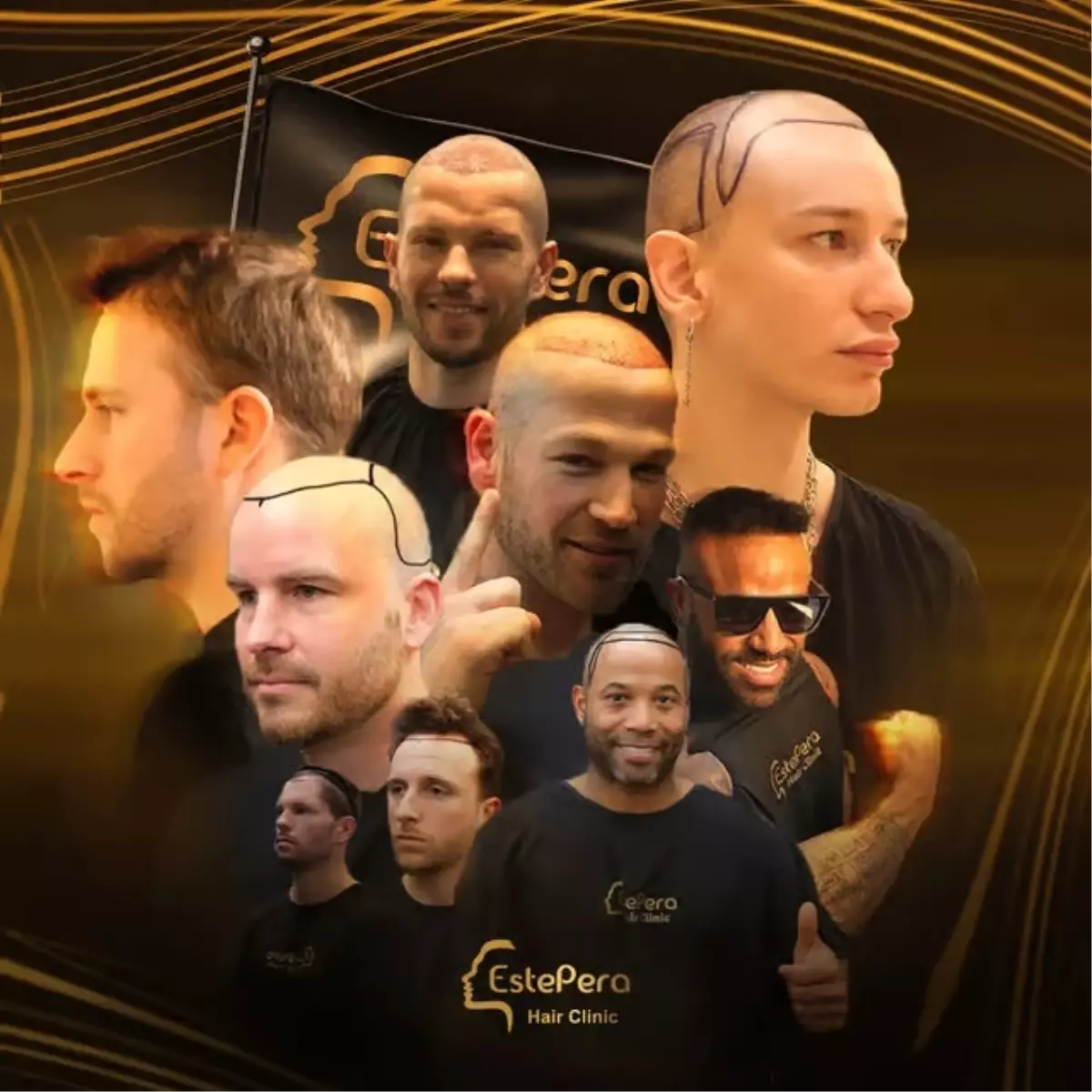 hair transplant in turkey why estepera leads the way in dhi sapphire fue and fue techniques qUEwQSFB.jpg